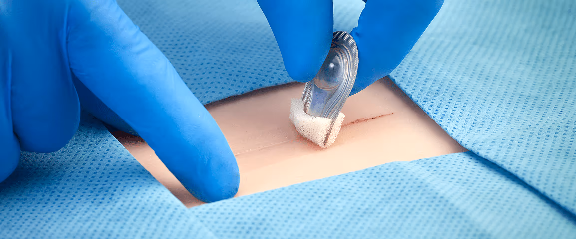 Closing the gaps for wound closure