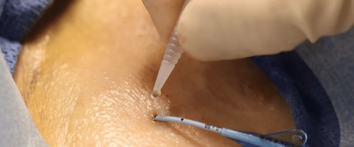 Revolutionizing catheter securement with Adhesives